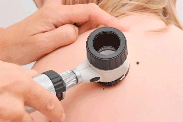 Curso métodos diagnósticos aplicados às lesões melanocíticas